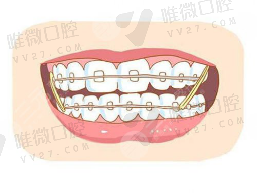 安装假牙和真牙有什么区别,拔牙后怎么装假牙(图1)